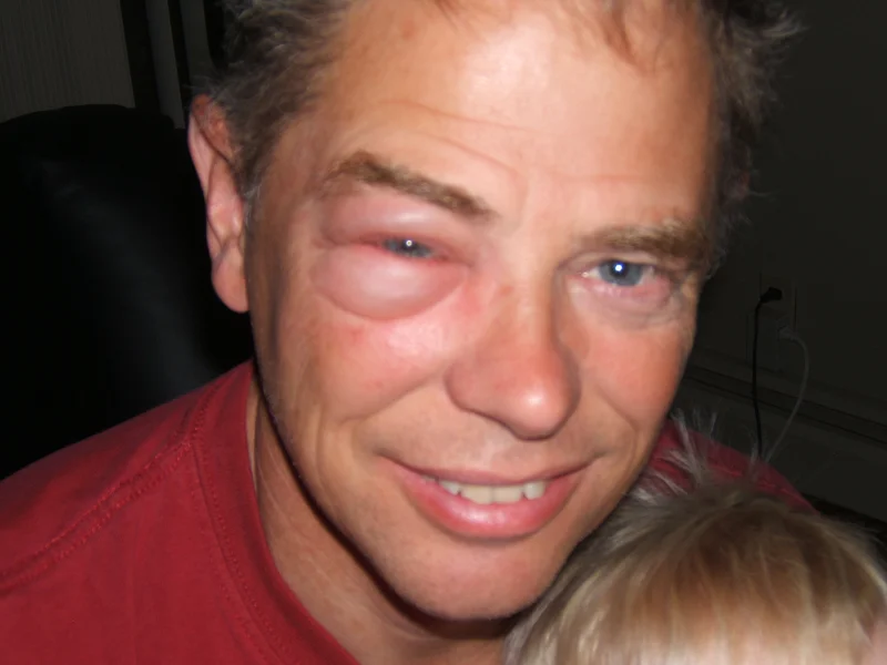 A Wasp Sting, a 911 Call, and Anxious Moments